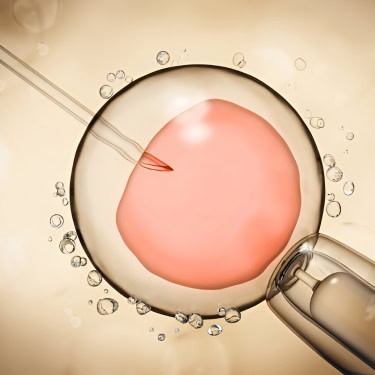 What is ICSI?